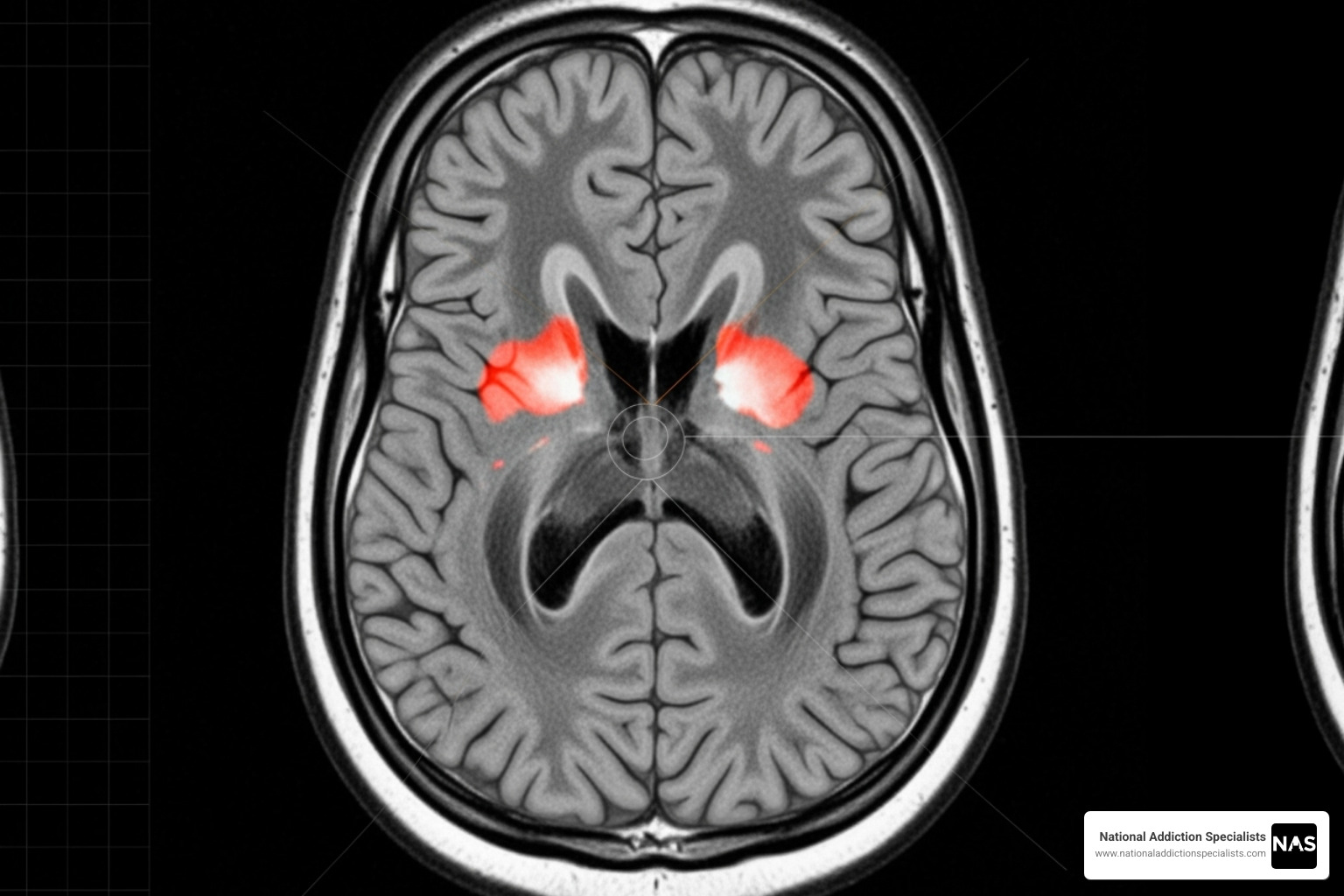 brain scan showing opioid effects - opioid addiction recovery