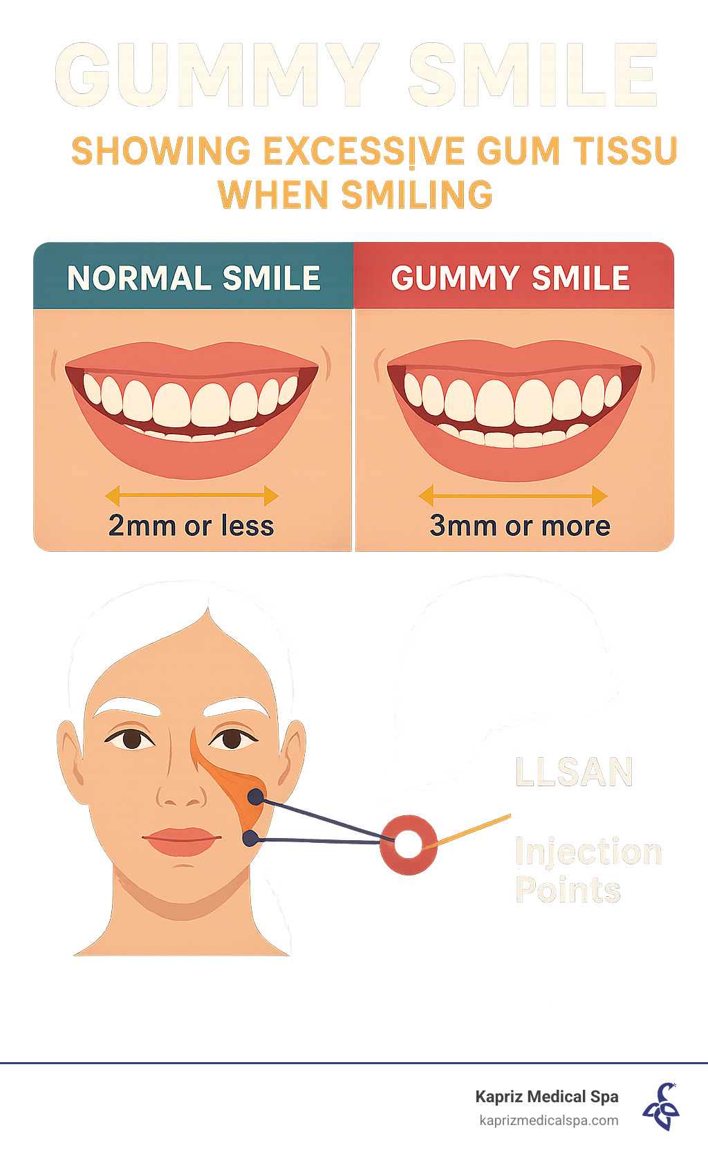 Infographic showing gummy smile definition with comparison of normal smile showing 2mm or less gum tissue versus gummy smile showing 3mm or more gum tissue, plus illustration of upper lip muscles LLSAN and injection points for treatment - how many units for gummy smile infographic Infographic showing gummy smile definition with comparison of normal smile showing 2mm or less gum tissue versus gummy smile showing 3mm or more gum tissue, plus illustration of upper lip muscles LLSAN and injection points for treatment - how many units for gummy smile infographic