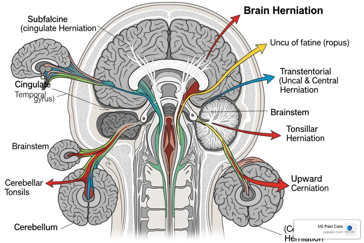 diagram of brain herniation types - herniation diagram of brain herniation types - herniation