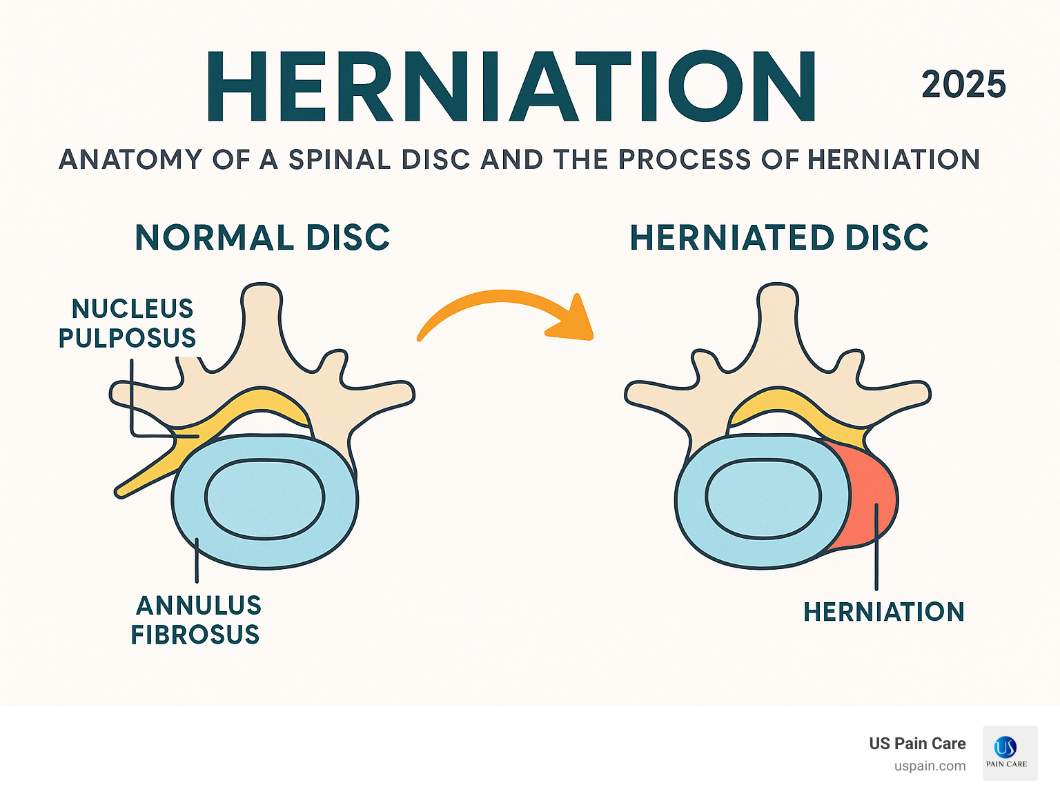 infographic explaining the anatomy of a spinal disc and the process of herniation - herniation infographic infographic explaining the anatomy of a spinal disc and the process of herniation - herniation infographic