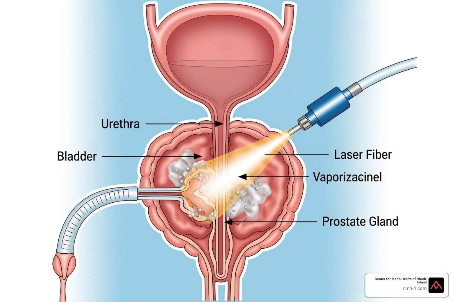animated diagram showing laser prostate surgery - does the laser treatment for bph cause bleeding periodically animated diagram showing laser prostate surgery - does the laser treatment for bph cause bleeding periodically
