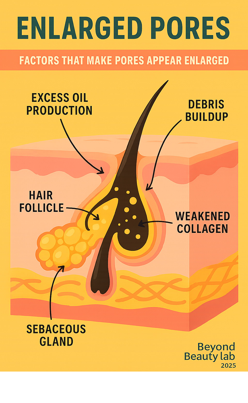 Infographic showing cross-section of a skin pore with labeled components including sebaceous gland, hair follicle, and collagen structure, plus factors that make pores appear enlarged such as excess oil production, weakened collagen, and debris buildup - best treatment for shrinking pores infographic 