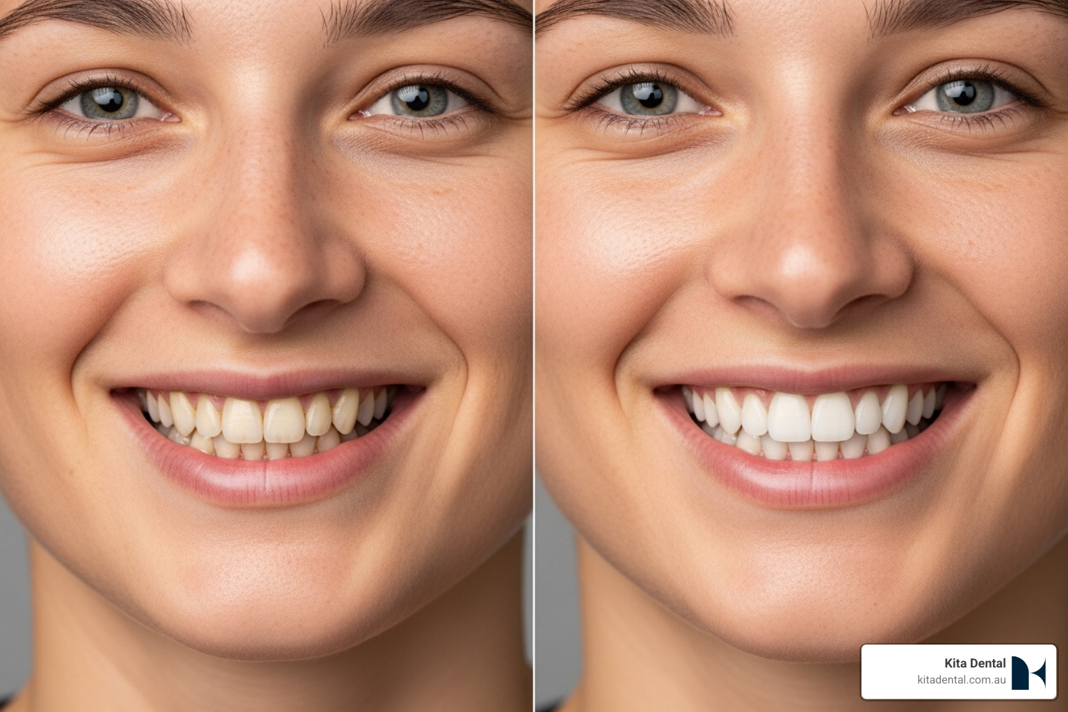 before-and-after smile change - cosmetic dentist north sydney before-and-after smile change - cosmetic dentist north sydney