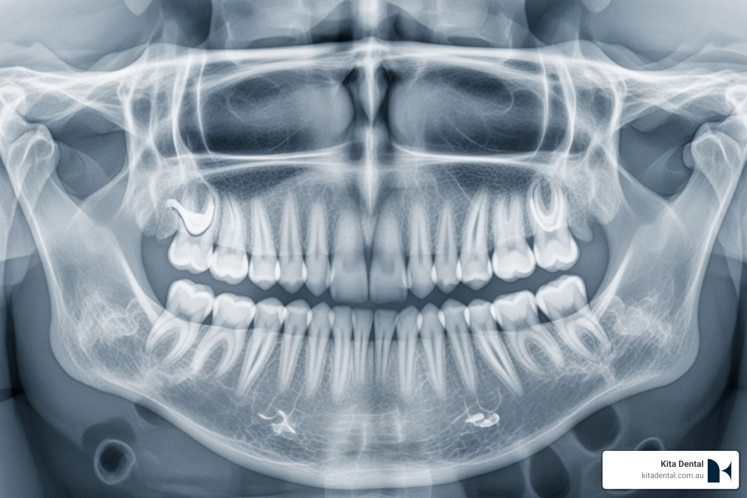 Image of a healthy jawbone X-ray suitable for implants. - implant treatment Image of a healthy jawbone X-ray suitable for implants. - implant treatment