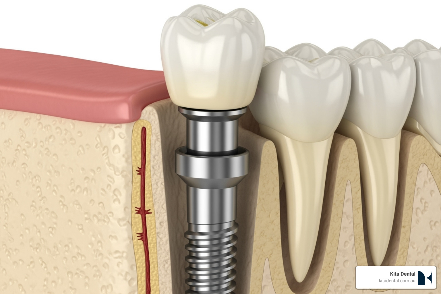 Diagram showing a dental implant integrated into the jawbone, with labels for the titanium post, abutment, and crown - best dental implants Diagram showing a dental implant integrated into the jawbone, with labels for the titanium post, abutment, and crown - best dental implants