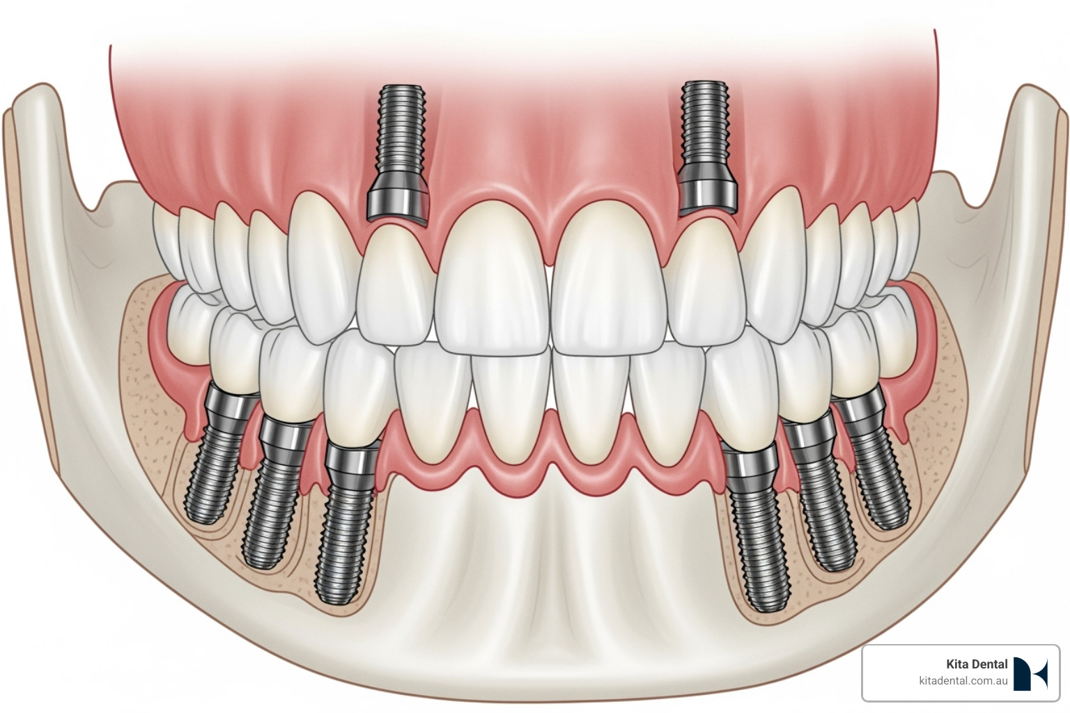 diagram of the full arch implant technique with strategically placed implants - full arch dental implants diagram of the full arch implant technique with strategically placed implants - full arch dental implants