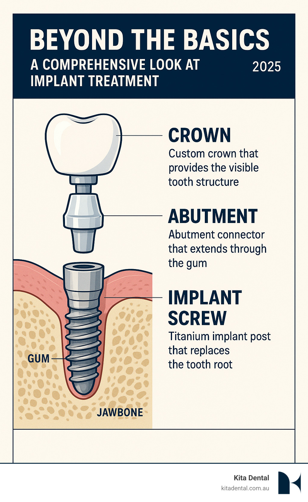 Comprehensive guide showing the three core components of dental implants - the titanium implant post that replaces the tooth root, the abutment connector that extends through the gum, and the custom crown that provides the visible tooth structure, with detailed cross-section view of how each component integrates with natural jawbone and gum tissue - implant treatment infographic Comprehensive guide showing the three core components of dental implants - the titanium implant post that replaces the tooth root, the abutment connector that extends through the gum, and the custom crown that provides the visible tooth structure, with detailed cross-section view of how each component integrates with natural jawbone and gum tissue - implant treatment infographic