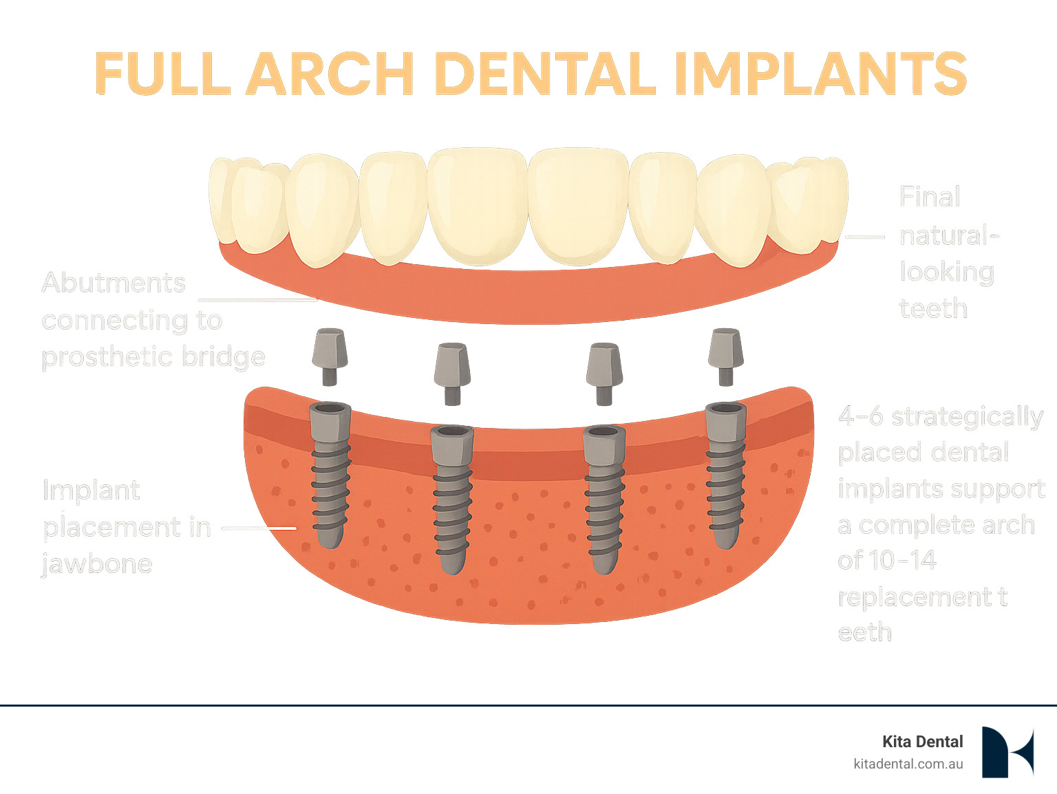 Infographic showing how 4-6 strategically placed dental implants can support a complete arch of 10-14 replacement teeth, with labels indicating implant placement in jawbone, abutments connecting to prosthetic bridge, and final natural-looking teeth - full arch dental implants infographic Infographic showing how 4-6 strategically placed dental implants can support a complete arch of 10-14 replacement teeth, with labels indicating implant placement in jawbone, abutments connecting to prosthetic bridge, and final natural-looking teeth - full arch dental implants infographic