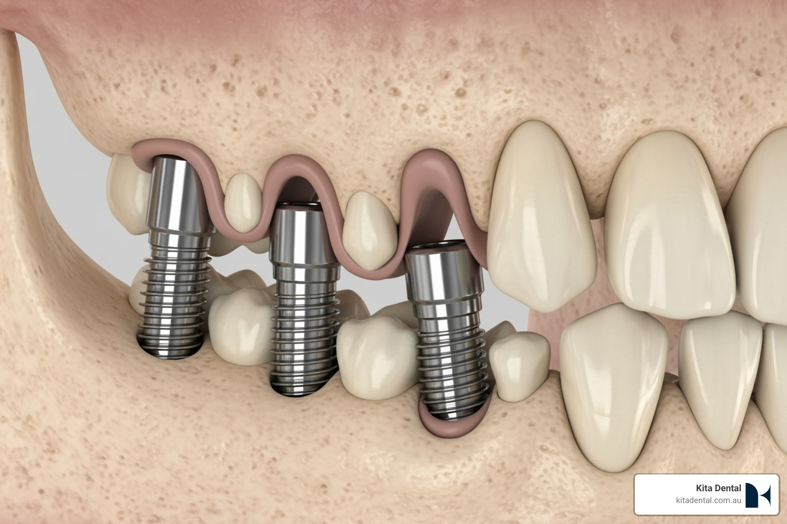 Image showing angled All-on-4 implants avoiding the need for a sinus lift - Bone grafting Vs Graft-less approach for implant Image showing angled All-on-4 implants avoiding the need for a sinus lift - Bone grafting Vs Graft-less approach for implant