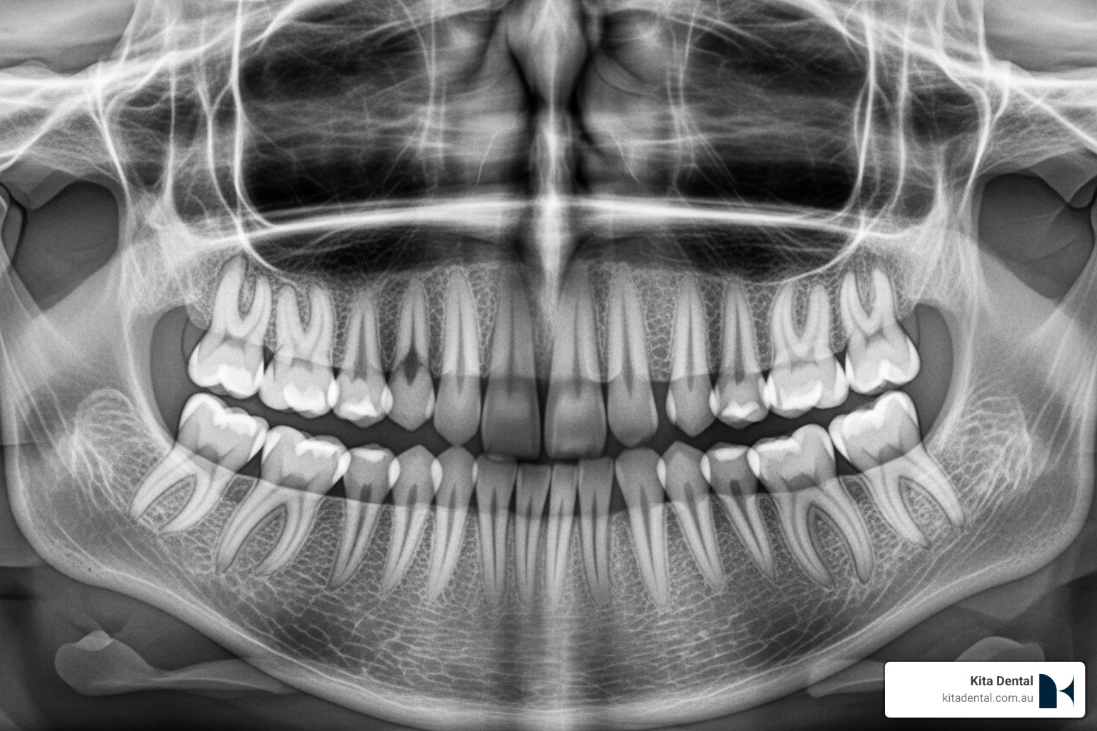 Dental X-ray showing areas of jawbone loss next to a healthy jawbone structure - Bone grafting Vs Graft-less approach for implant Dental X-ray showing areas of jawbone loss next to a healthy jawbone structure - Bone grafting Vs Graft-less approach for implant