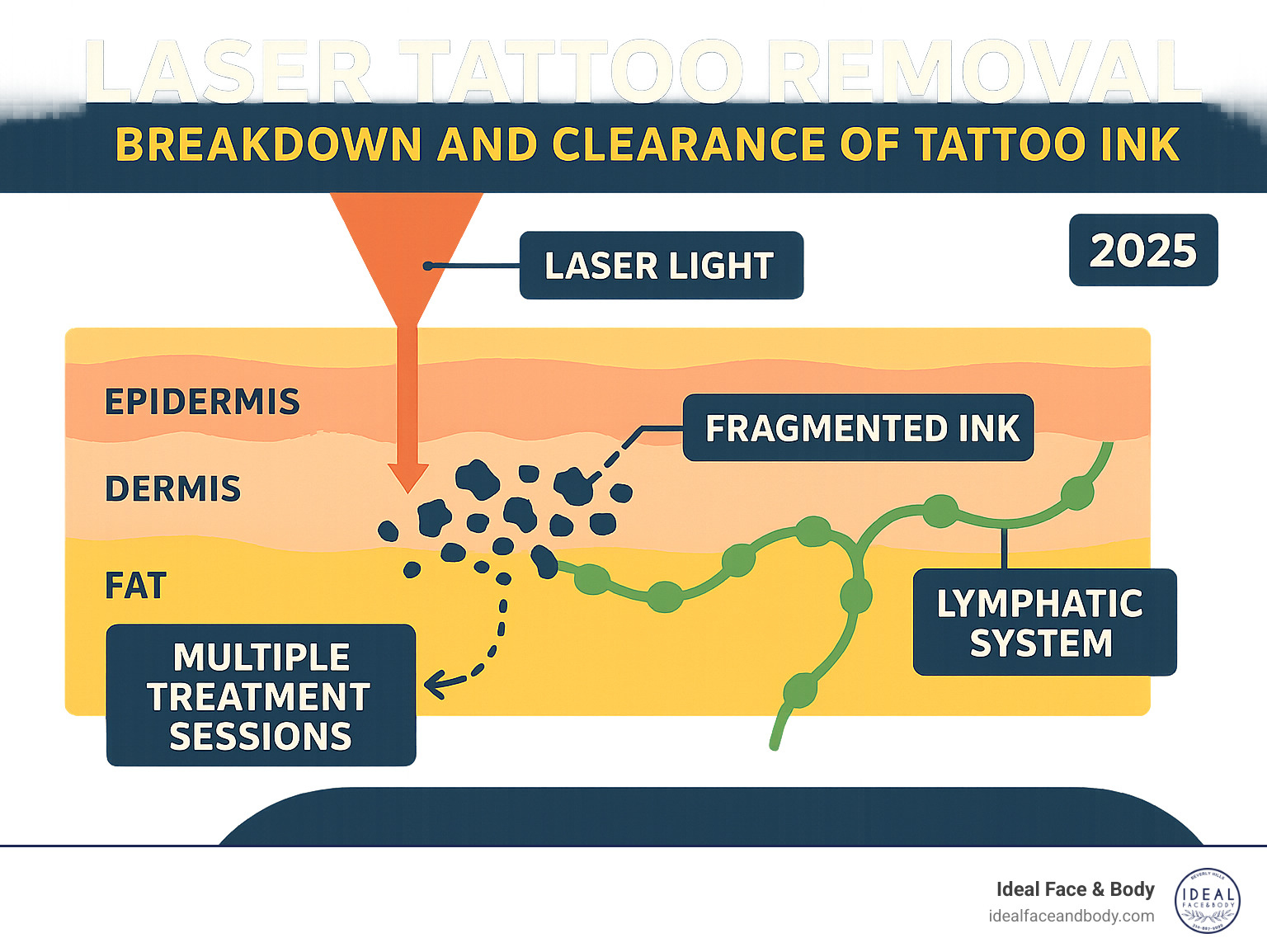 Infographic showing laser light penetrating skin layers to break up tattoo ink particles, with the body's lymphatic system clearing away the fragmented ink over time through multiple treatment sessions - Tattoo removal Beverly Hills, CA infographic 