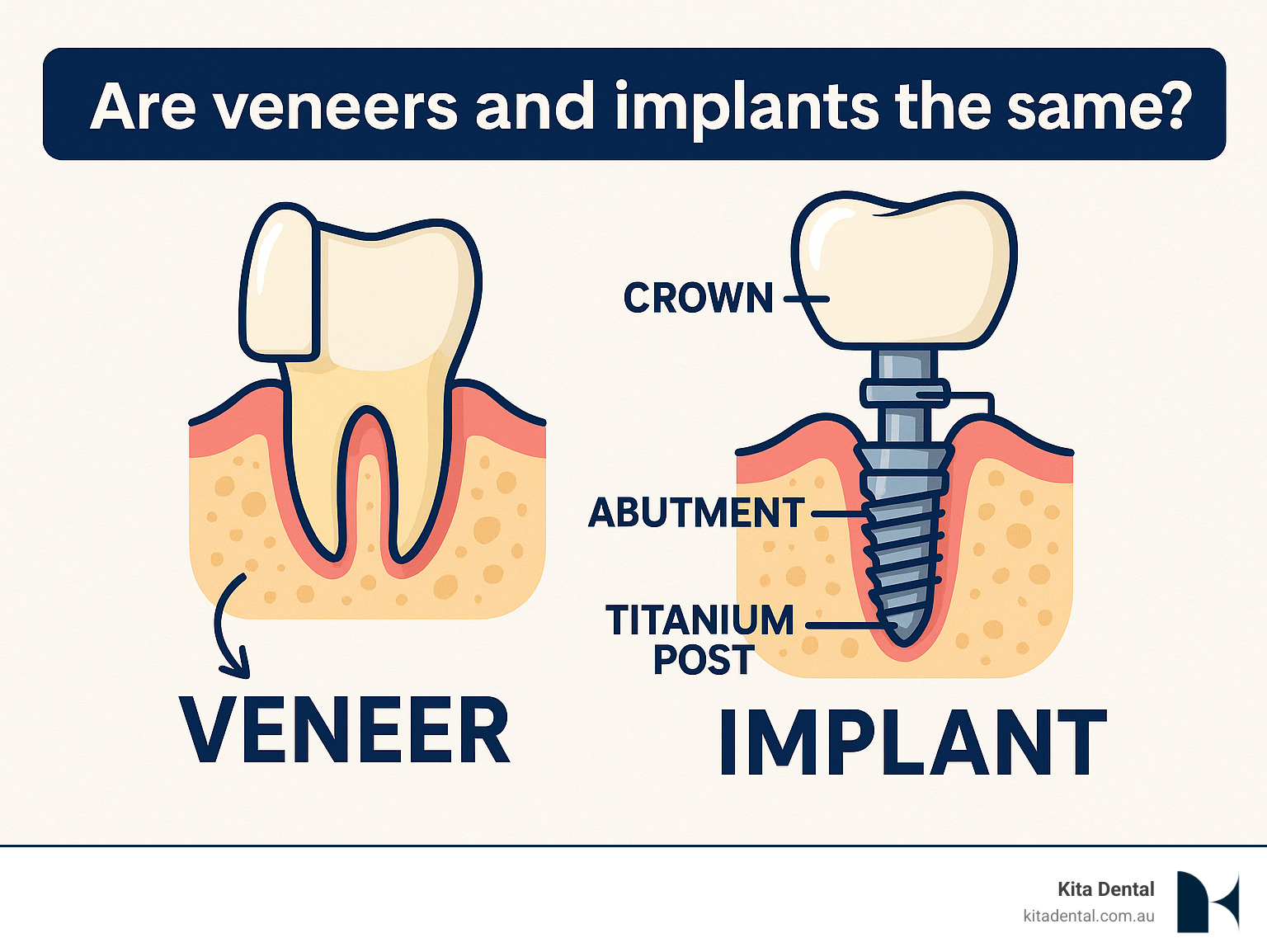 Infographic showing a cross-section comparison of a dental implant replacing an entire tooth including the root versus a veneer covering only the front surface of an existing natural tooth, with labels indicating implant components (titanium post, abutment, crown) and veneer placement over natural tooth structure - are veneers and implants the same infographic Infographic showing a cross-section comparison of a dental implant replacing an entire tooth including the root versus a veneer covering only the front surface of an existing natural tooth, with labels indicating implant components (titanium post, abutment, crown) and veneer placement over natural tooth structure - are veneers and implants the same infographic