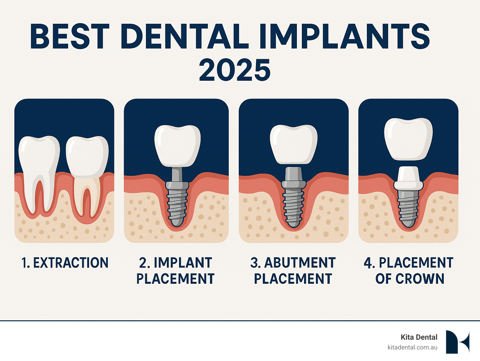Illustration depicting the step-by-step process of dental implant placement, from initial extraction to final crown attachment - best dental implants Illustration depicting the step-by-step process of dental implant placement, from initial extraction to final crown attachment - best dental implants
