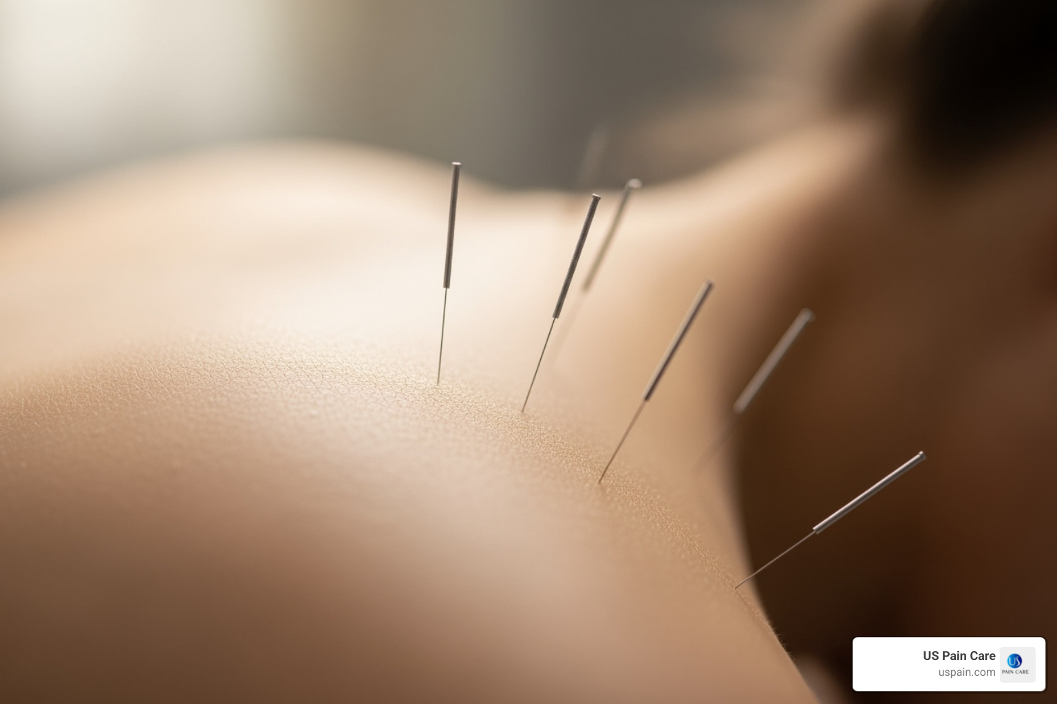 A close-up of an acupuncture session, showing needles on a person's back - pain relief alternative therapies