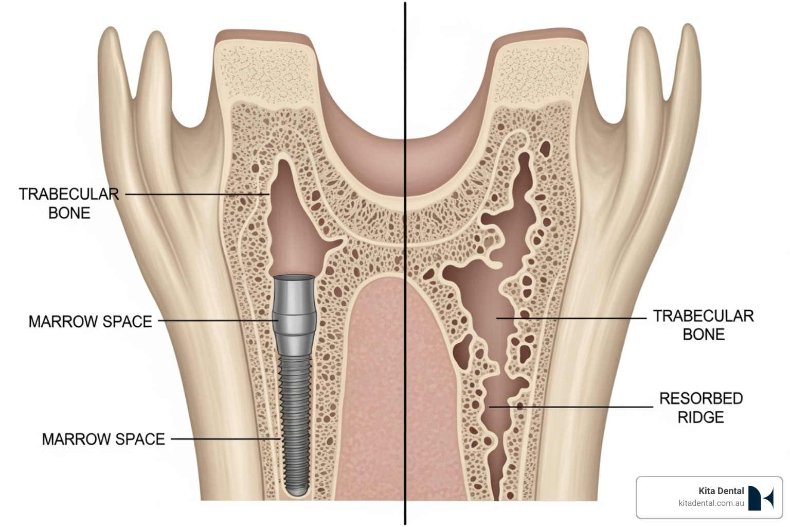 illustrating good vs. poor jawbone density for implants - full mouth implant treatment illustrating good vs. poor jawbone density for implants - full mouth implant treatment
