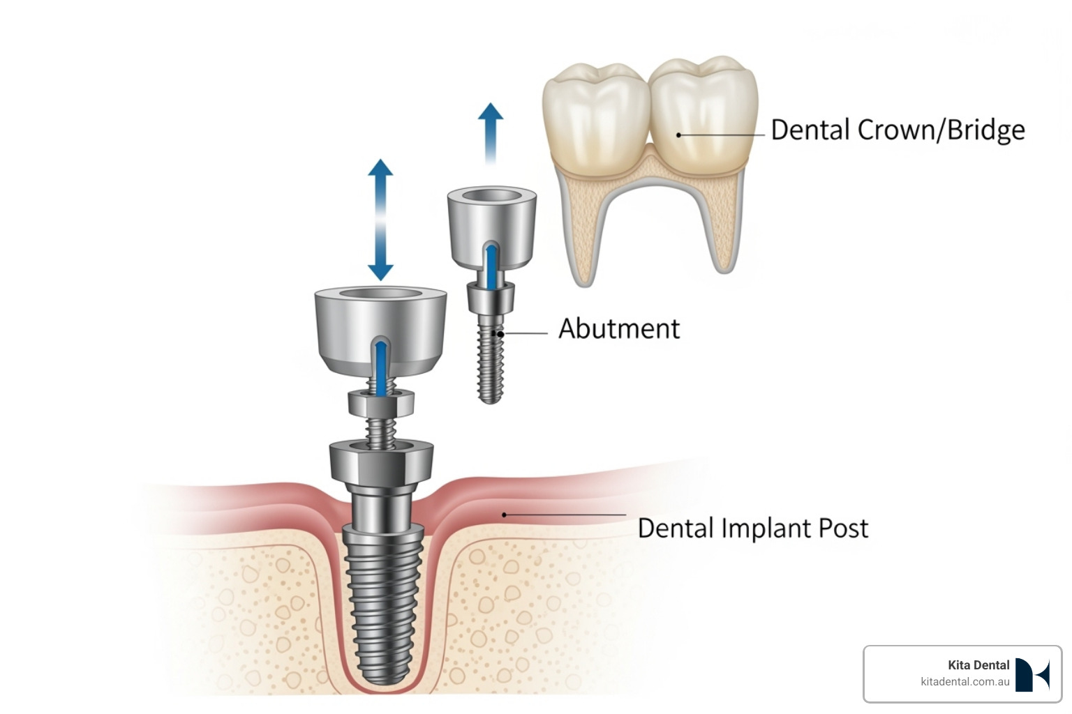 diagram showing the three main components of a dental implant system - full mouth implant treatment diagram showing the three main components of a dental implant system - full mouth implant treatment