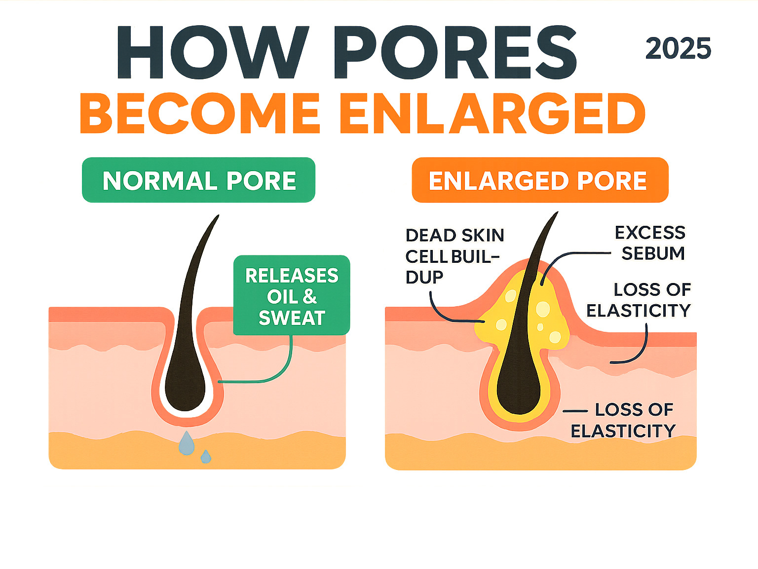 Comprehensive infographic showing cross-section of normal versus enlarged pores, highlighting sebum production, dead skin cell buildup, loss of elasticity factors, and the skin's natural oil and sweat release function - what is the best way to reduce large pores infographic 