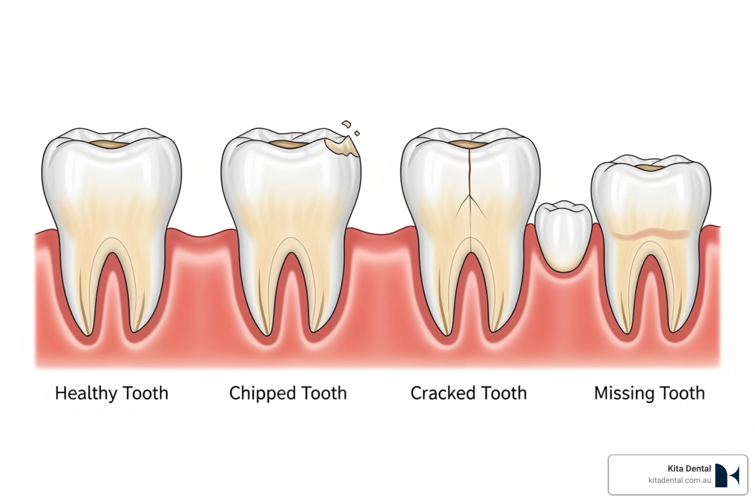 diagram showing a healthy tooth, a chipped tooth, a cracked tooth, and a missing tooth - how to choose between veneers, crowns, or implants diagram showing a healthy tooth, a chipped tooth, a cracked tooth, and a missing tooth - how to choose between veneers, crowns, or implants