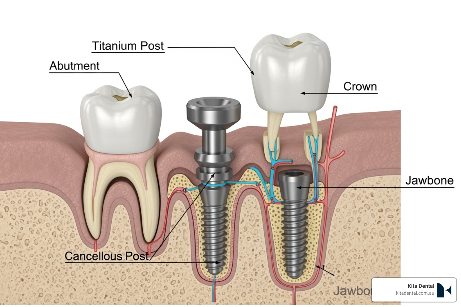 detailed dental implant diagram showing the post, abutment, and crown - how to choose between veneers, crowns, or implants detailed dental implant diagram showing the post, abutment, and crown - how to choose between veneers, crowns, or implants
