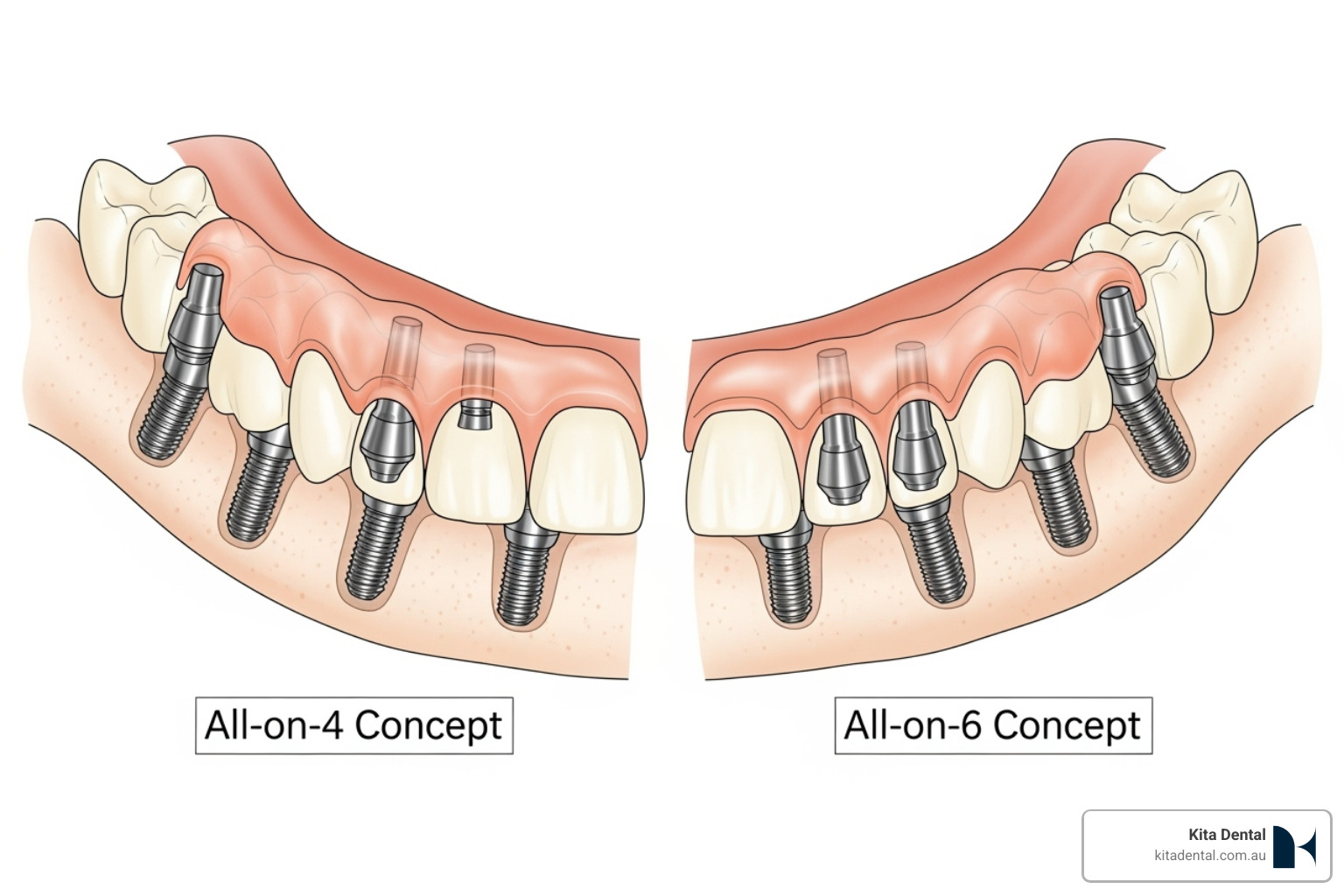 illustration of the difference in implant placement between All-on-4 and All-on-6 - Implant treatment, full- arch treatment illustration of the difference in implant placement between All-on-4 and All-on-6 - Implant treatment, full- arch treatment
