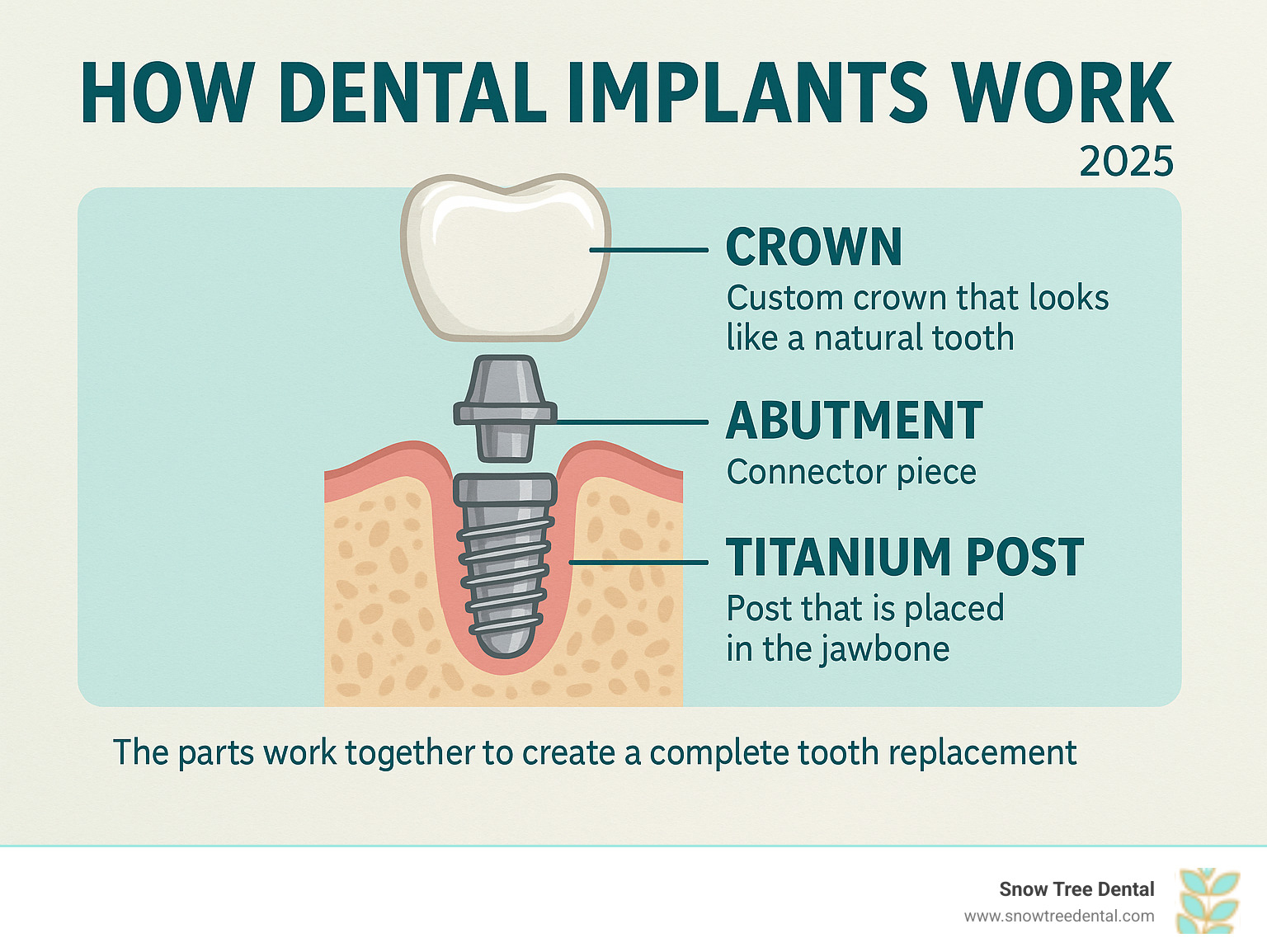 Infographic showing the three main components of a dental implant: the titanium post that goes into the jawbone, the abutment connector piece, and the custom crown that looks like a natural tooth, with labels explaining how each part works together to create a complete tooth replacement - dental implants 77057 infographic 