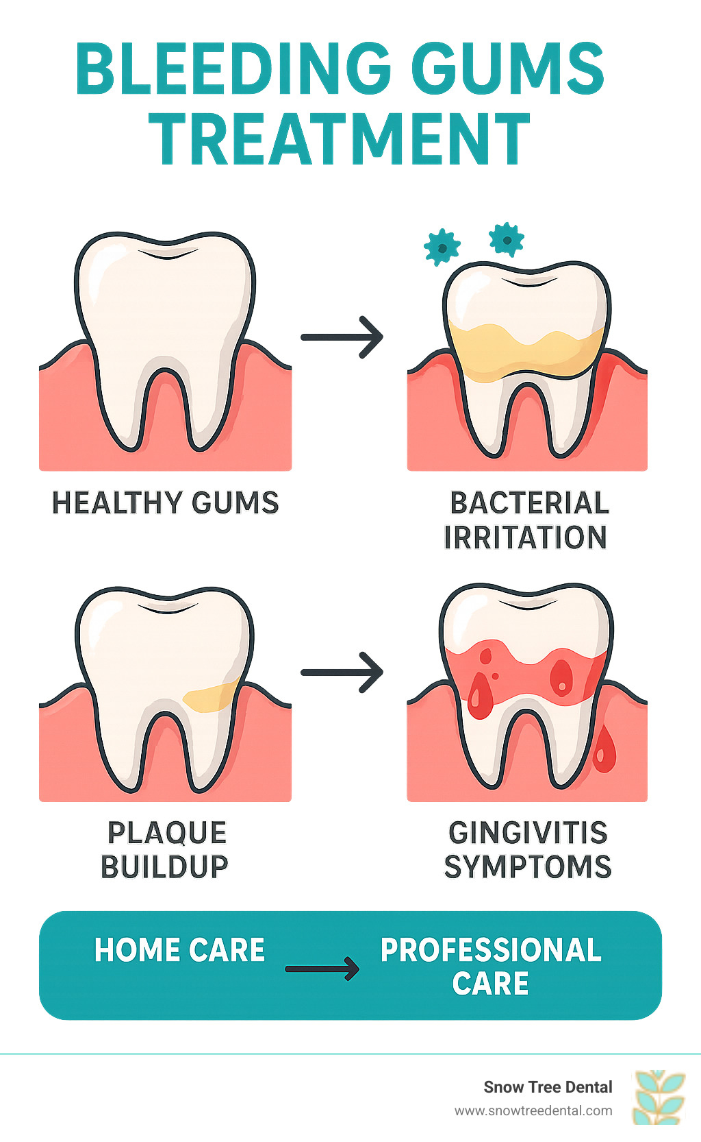 Detailed infographic showing the progression from healthy pink gums to inflamed red bleeding gums, with labels for plaque buildup, bacterial irritation, gingivitis symptoms, and treatment timeline from home care to professional intervention - bleeding gums treatment infographic  Detailed infographic showing the progression from healthy pink gums to inflamed red bleeding gums, with labels for plaque buildup, bacterial irritation, gingivitis symptoms, and treatment timeline from home care to professional intervention - bleeding gums treatment infographic