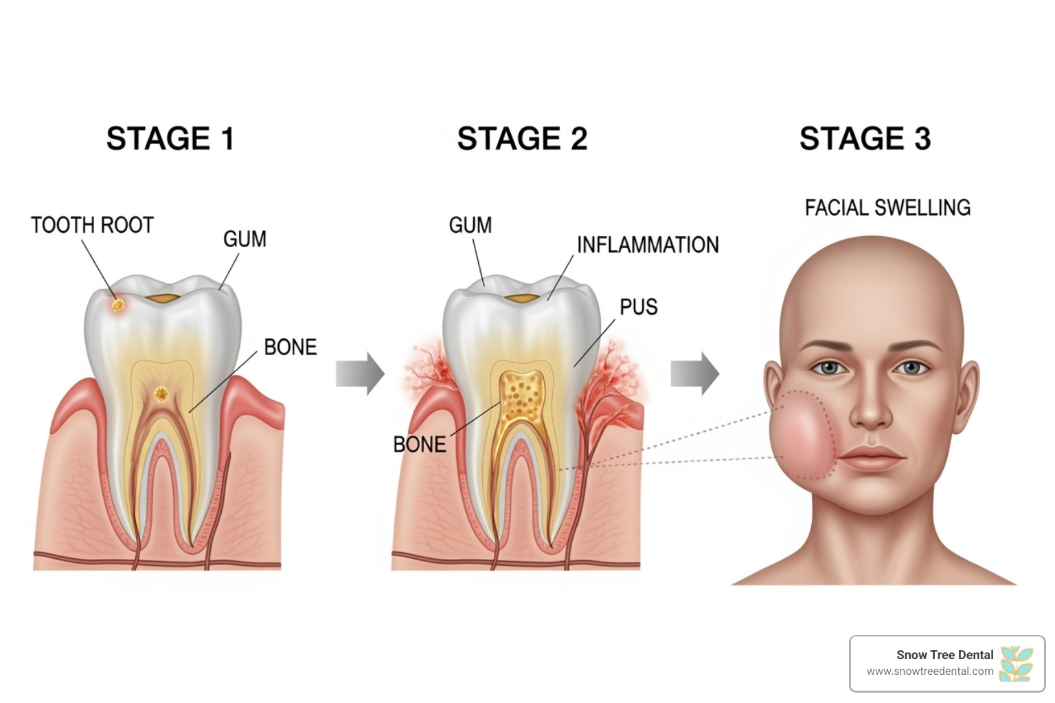 Illustration showing the progression of a dental abscess from initial infection to facial swelling. - 24/7 dental Illustration showing the progression of a dental abscess from initial infection to facial swelling. - 24/7 dental