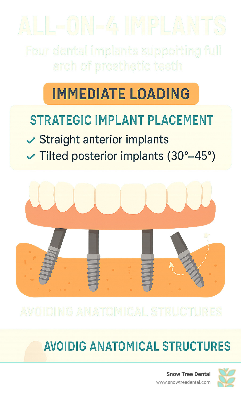 Infographic showing four dental implants strategically placed in the jawbone - two straight anterior implants and two tilted posterior implants at 30-45 degree angles, supporting a complete arch of prosthetic teeth with immediate loading capability and avoiding anatomical structures - all on four implants infographic 