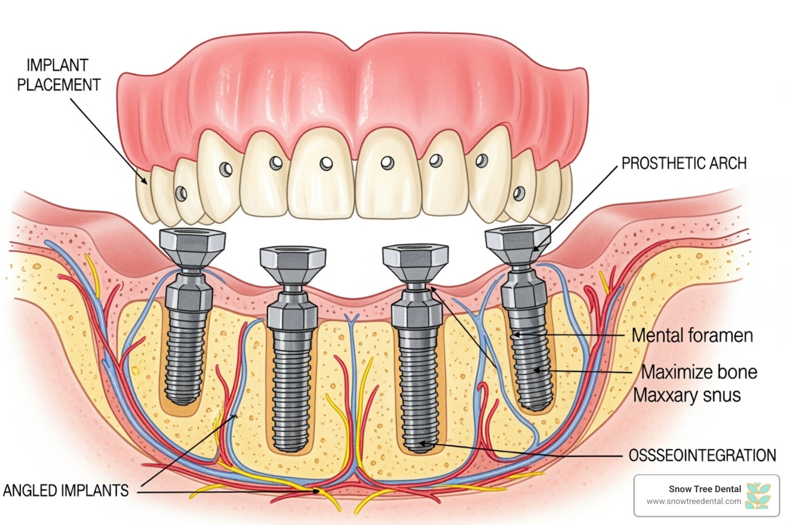diagram showing the All-on-4 implant procedure - dental implant specialist Houston diagram showing the All-on-4 implant procedure - dental implant specialist Houston