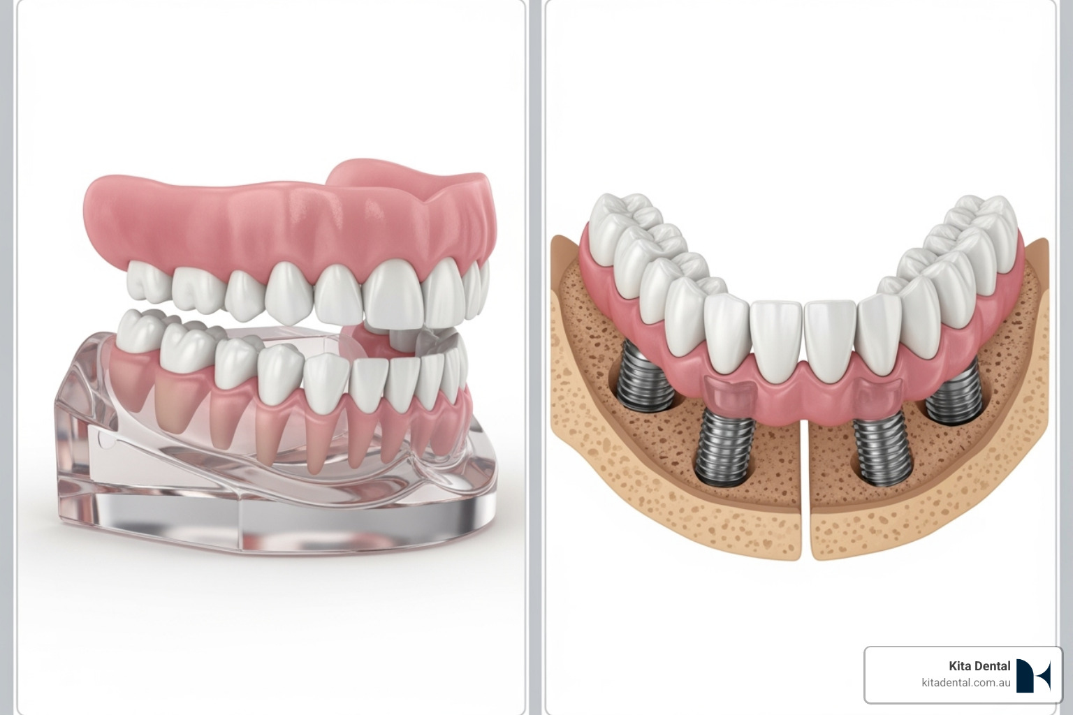 Image illustrating the difference between a removable denture and a fixed implant arch, showcasing the stability of fixed implants - full arch implant surgery Image illustrating the difference between a removable denture and a fixed implant arch, showcasing the stability of fixed implants - full arch implant surgery