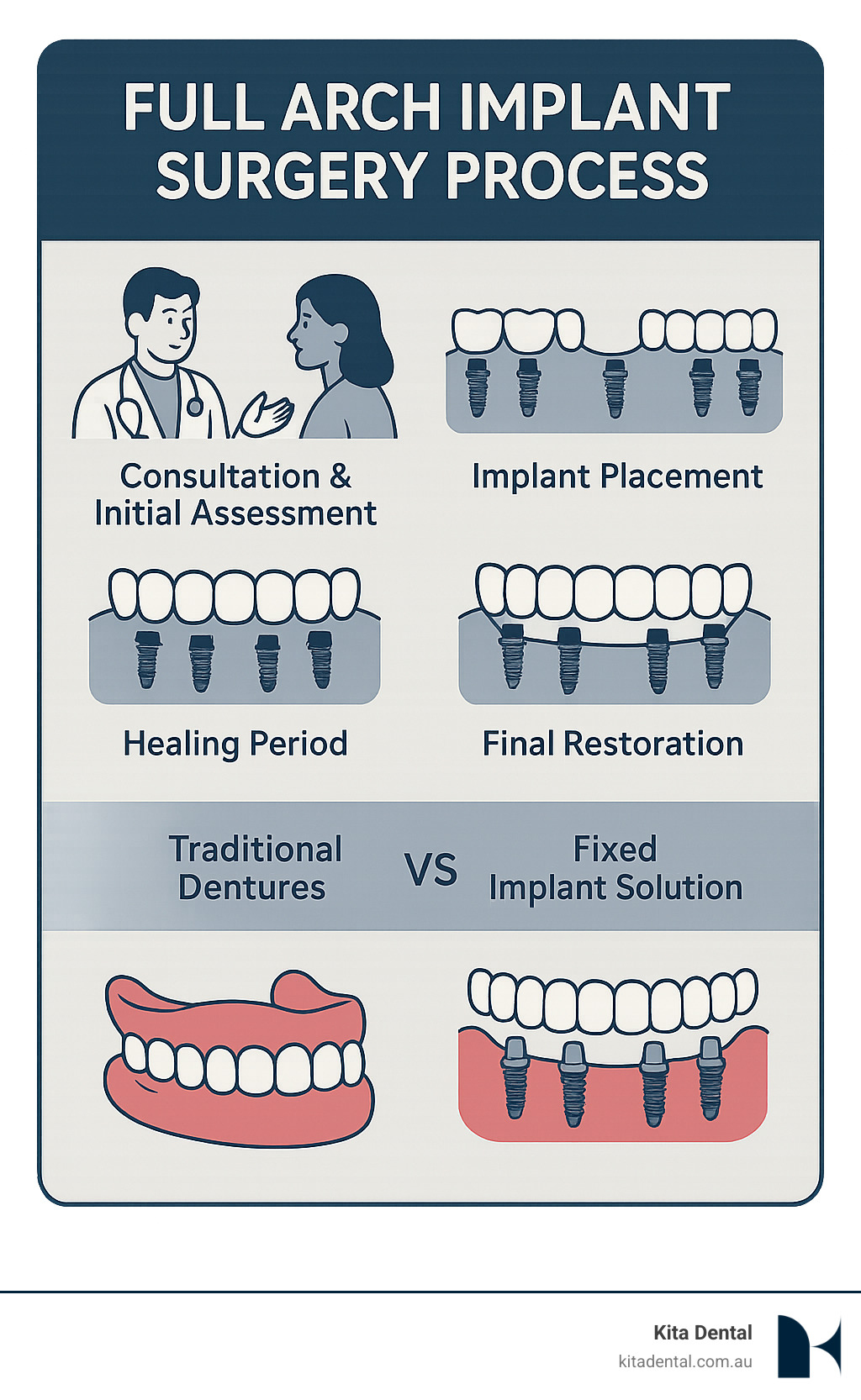 Infographic showing full arch implant surgery process from consultation through final restoration, including steps of initial assessment, implant placement, healing period, and final prosthesis fitting with comparison between traditional dentures and fixed implant solution - full arch implant surgery infographic Infographic showing full arch implant surgery process from consultation through final restoration, including steps of initial assessment, implant placement, healing period, and final prosthesis fitting with comparison between traditional dentures and fixed implant solution - full arch implant surgery infographic