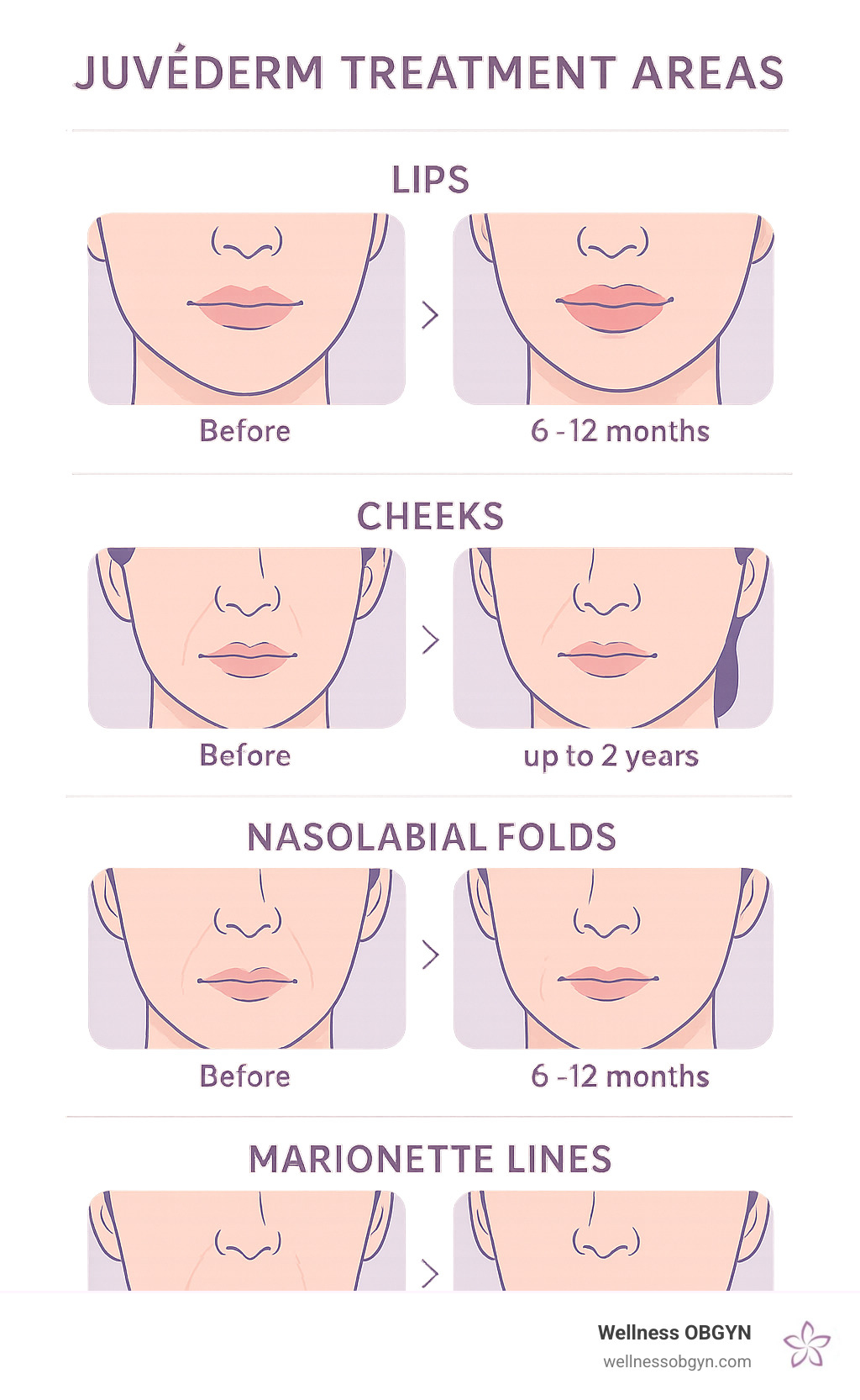 Comprehensive infographic showing Juvederm treatment areas including lips, cheeks, nasolabial folds, and marionette lines, with before and after comparison illustrations and duration of results for each area - juvederm for lips infographic Comprehensive infographic showing Juvederm treatment areas including lips, cheeks, nasolabial folds, and marionette lines, with before and after comparison illustrations and duration of results for each area - juvederm for lips infographic