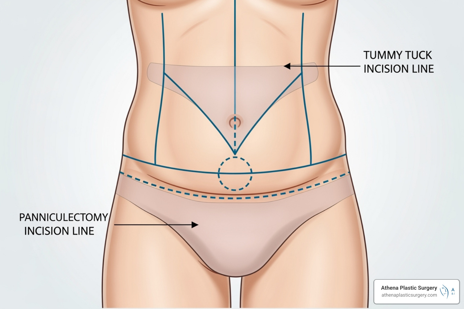 Diagram contrasting panniculectomy and tummy tuck goals - Loose skin surgery cost