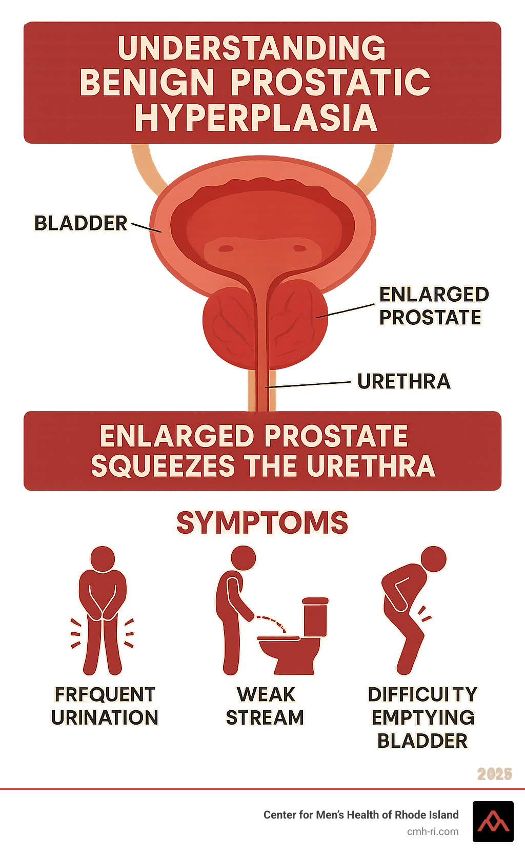 Benign prostatic hyperplasia: 3 Essential Steps to Relief