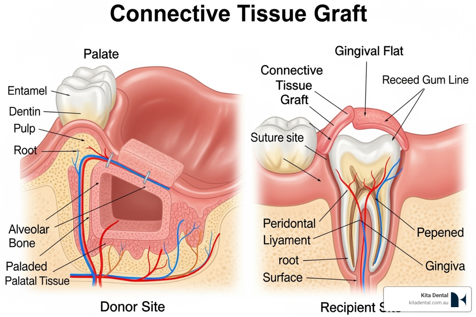 diagram of a connective-tissue graft procedure - gingival graft procedure diagram of a connective-tissue graft procedure - gingival graft procedure