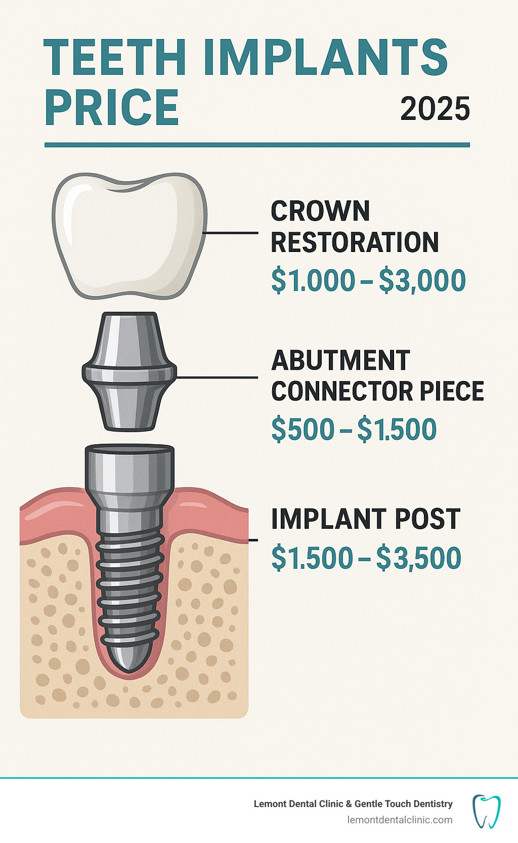 Comprehensive breakdown of dental implant components showing implant post inserted into jawbone, abutment connector piece, and crown restoration with individual cost ranges for each component - teeth implants price infographic 