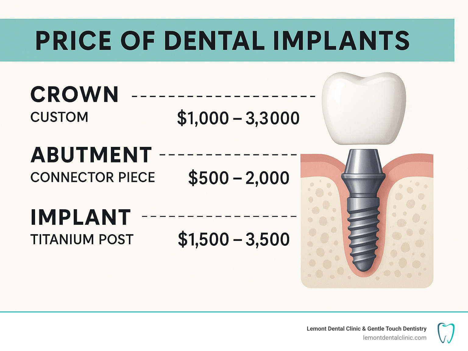 Detailed breakdown of dental implant components showing the three main parts: titanium implant post that goes into the jawbone, the abutment connector piece, and the custom crown that looks like a natural tooth, with cost ranges for each component - price of dental implants infographic 
