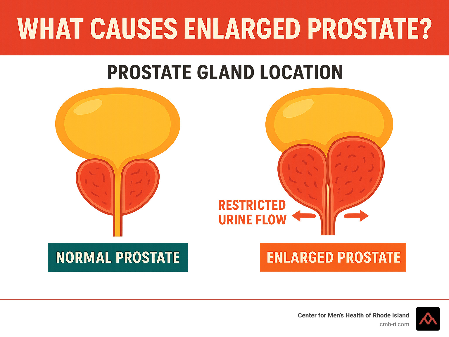 Infographic showing the prostate gland location surrounding the urethra, with comparison between normal prostate size and enlarged prostate compressing the urethra and restricting urine flow - what causes enlarged prostate infographic 