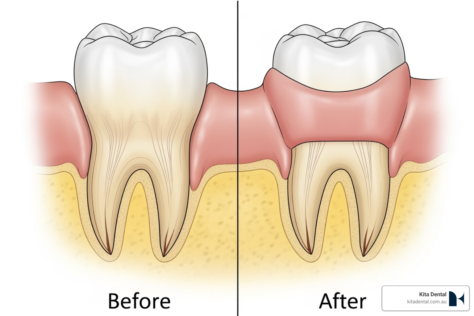 A detailed diagram illustrating the before and after of a gingival graft procedure, showing an exposed tooth root being covered by grafted tissue, resulting in a healthy, restored gum line. - gingival graft A detailed diagram illustrating the before and after of a gingival graft procedure, showing an exposed tooth root being covered by grafted tissue, resulting in a healthy, restored gum line. - gingival graft