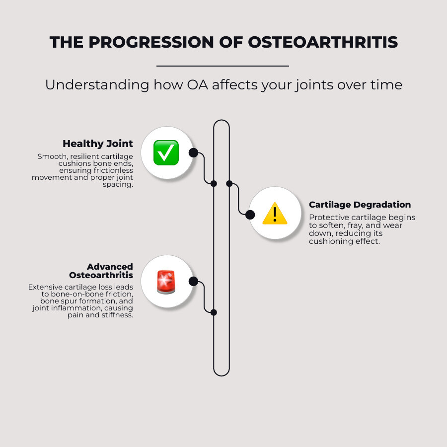 Detailed infographic showing the progression of osteoarthritis from a healthy joint with smooth cartilage and proper joint spacing to an arthritic joint with worn cartilage, bone spurs, narrowed joint space, and inflammation of surrounding tissues - osteoarthritis infographic infographic-line-3-steps-neat_beige