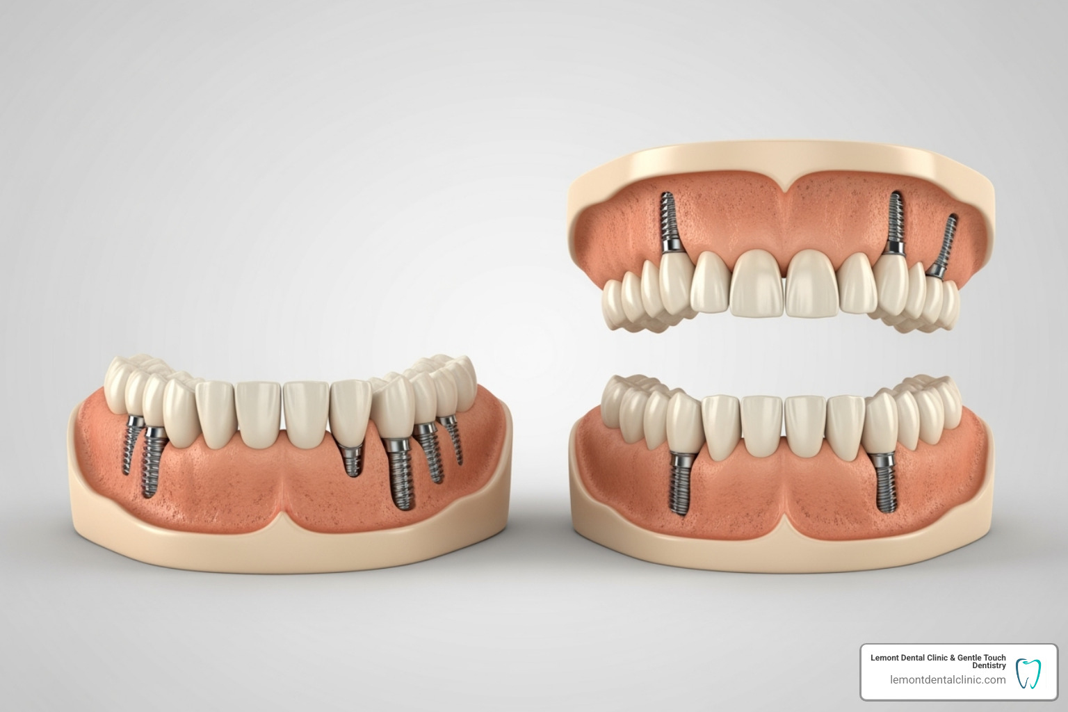 Illustration showing the difference between a single arch and a full mouth dental restoration - price of full mouth dental implants Illustration showing the difference between a single arch and a full mouth dental restoration - price of full mouth dental implants