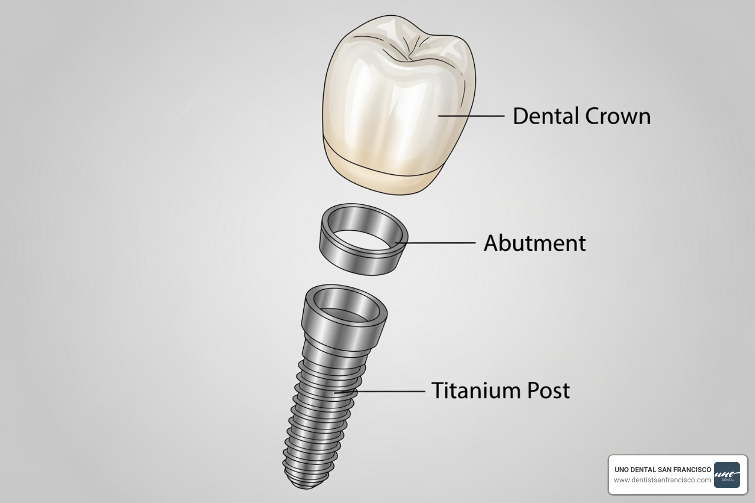 illustration of the three parts of a dental implant (post, abutment, crown) - How much dental implants