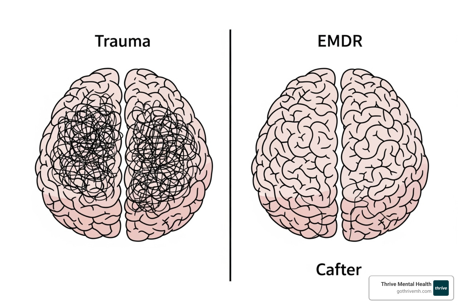 A simplified diagram illustrating the brain's response to trauma before EMDR (disrupted connections) and after EMDR (integrated, calm connections between the amygdala and prefrontal cortex). - emdr therapist