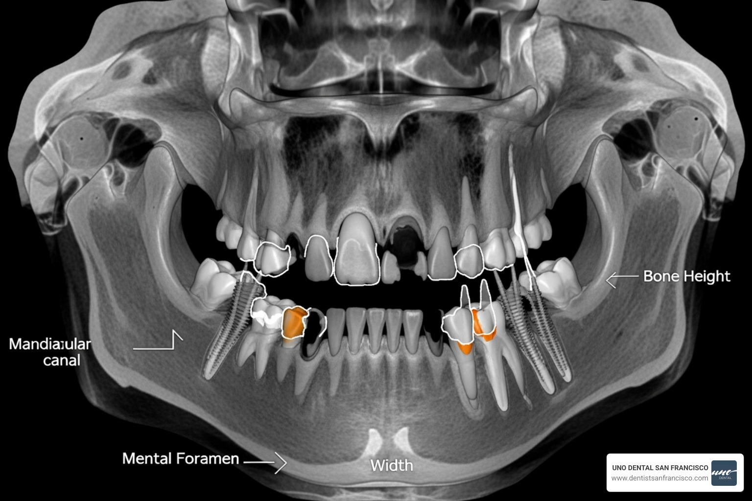 3D CBCT scan of a jaw showing bone structure and potential implant sites - cost of full mouth dental implants san francisco