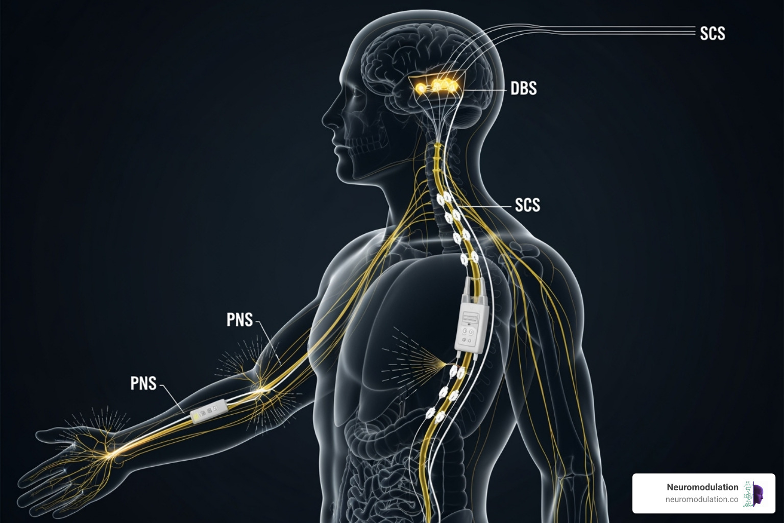 Illustration of various neuromodulation devices implanted in a human silhouette, including a spinal cord stimulator along the spine, a peripheral nerve stimulator near a limb nerve, and deep brain stimulation electrodes in the brain, with subtle lines indicating electrical impulses - is neuromodulation safe Illustration of various neuromodulation devices implanted in a human silhouette, including a spinal cord stimulator along the spine, a peripheral nerve stimulator near a limb nerve, and deep brain stimulation electrodes in the brain, with subtle lines indicating electrical impulses - is neuromodulation safe