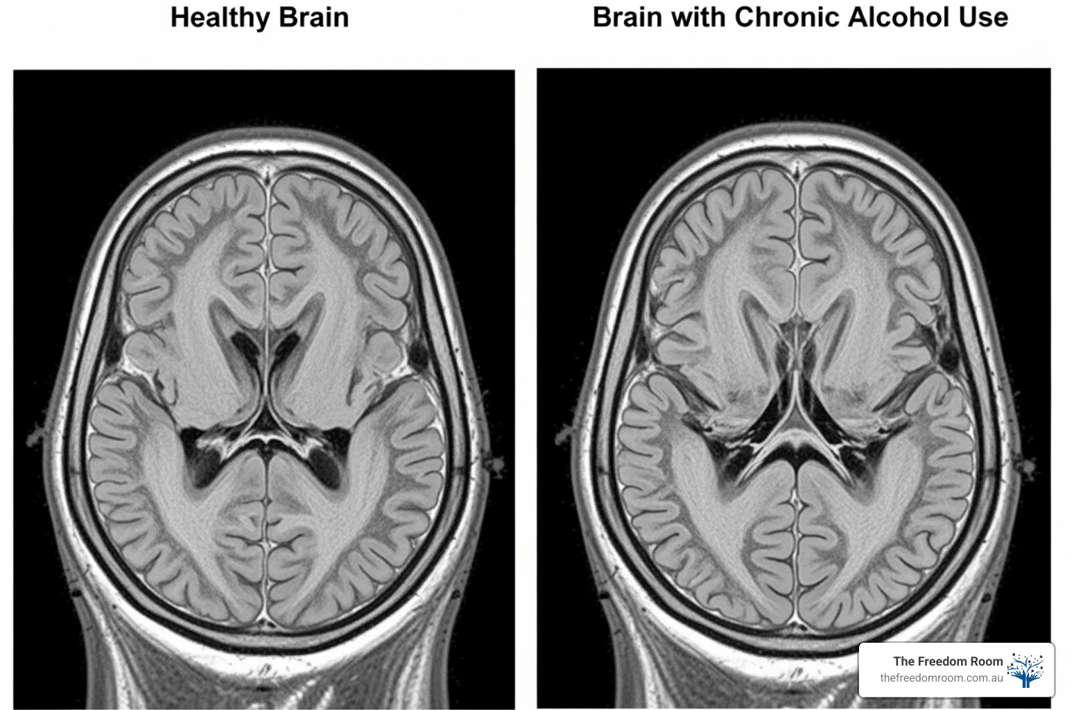 brain scan comparison showing healthy brain vs. brain affected by alcohol - Long-term alcohol recovery