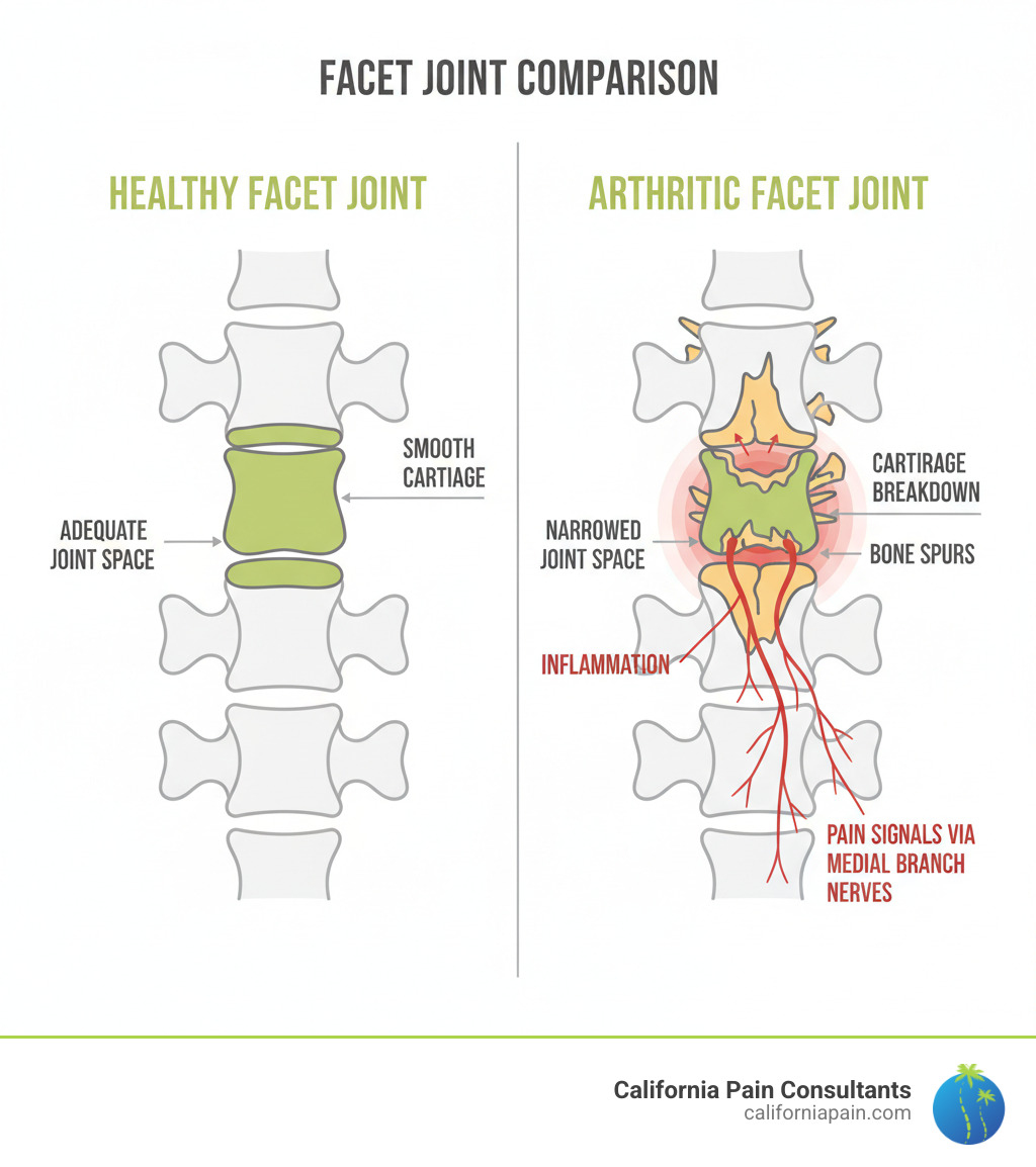 Infographic comparing a healthy facet joint with smooth cartilage surfaces and adequate joint space to an arthritic facet joint showing cartilage breakdown, bone spurs, inflammation, and narrowed joint space, with labels indicating pain signals traveling through medial branch nerves - Facet joint injections infographic 
