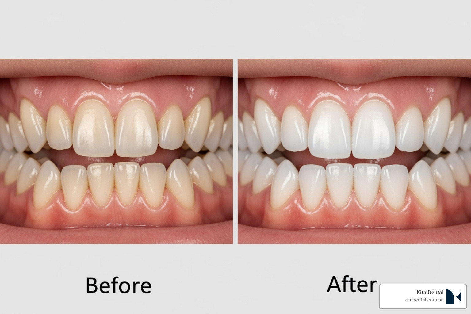 before-and-after teeth whitening - Coffee stain removal before-and-after teeth whitening - Coffee stain removal
