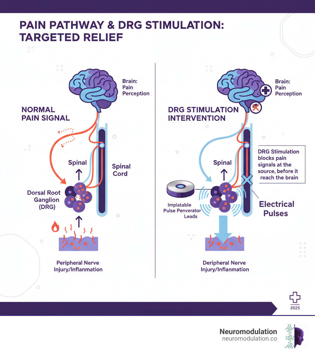 Detailed infographic showing the complete pain pathway from peripheral nerve injury or inflammation, through the dorsal root ganglion where pain signals are processed and amplified, along the spinal cord, and up to the brain where pain is perceived. The infographic highlights how DRG stimulation interrupts this pathway at the dorsal root ganglion level, before signals reach the spinal cord and brain. Includes labeled anatomical structures: peripheral nerves, dorsal root ganglion, spinal cord, and brain regions involved in pain processing. Shows the DRG stimulator device with leads positioned at the ganglion and the implantable pulse generator, with arrows indicating where electrical pulses block pain signal transmission. - DRG for chronic pain infographic 