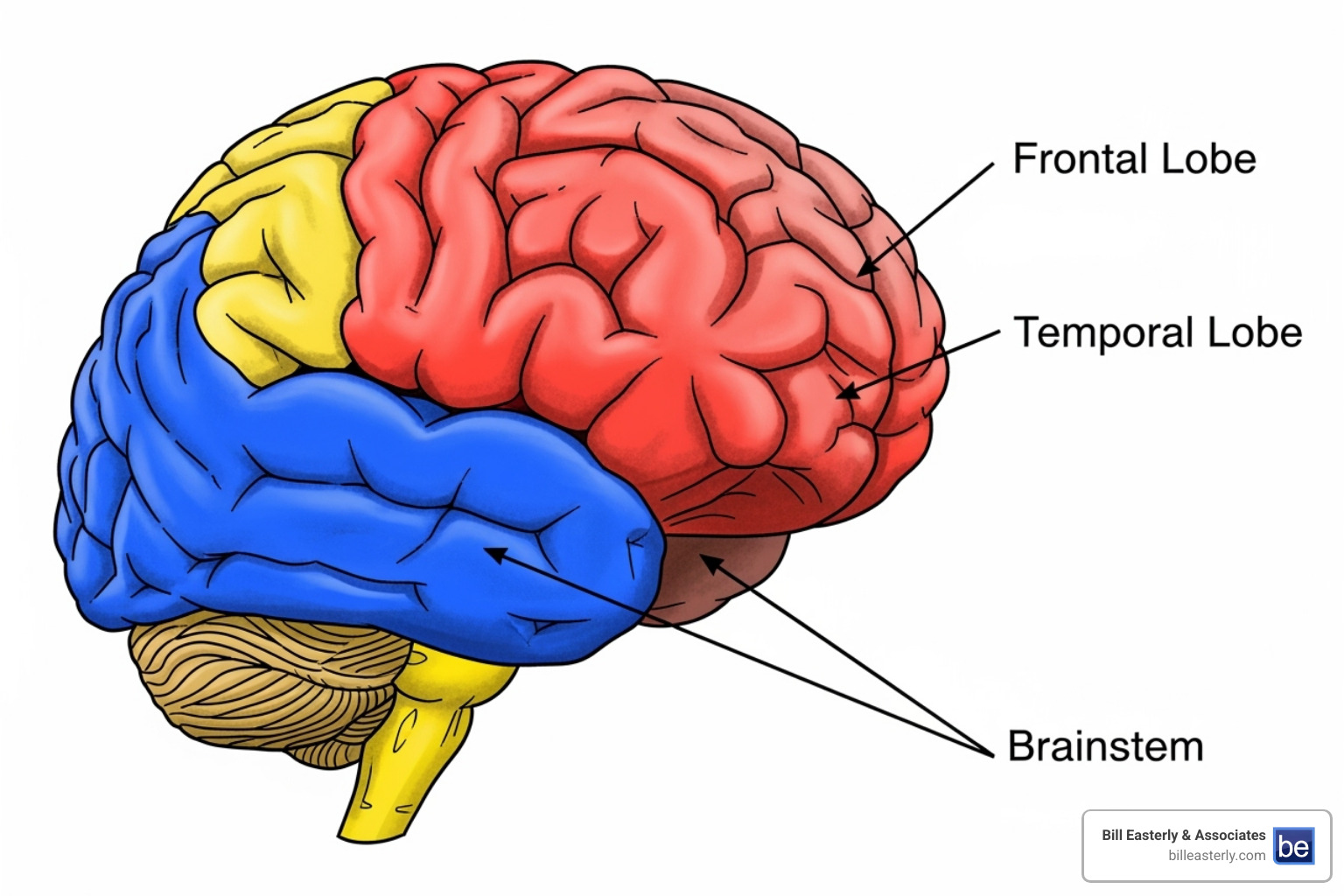 Image of a brain diagram highlighting areas affected by TBI, with arrows pointing to common injury locations like the frontal lobe, temporal lobe, and brainstem. - Traumatic brain injury Nashville